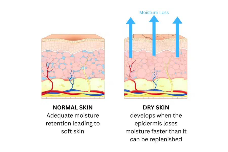 dry skin mechanism: Diagram showing how dry skin occurs with damaged skin barrier and moisture loss