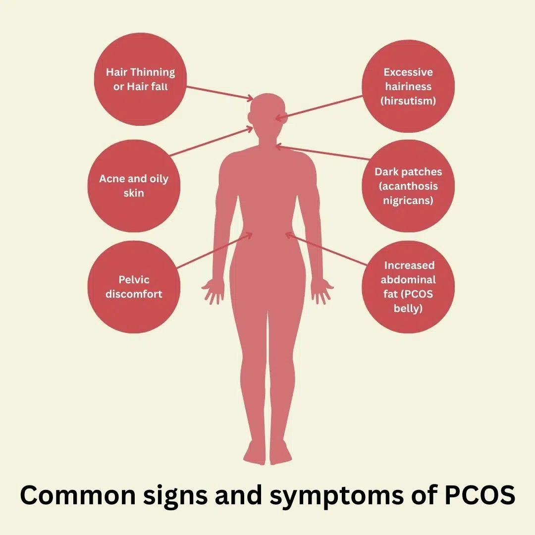 diagram showing different symptoms of PCOS.