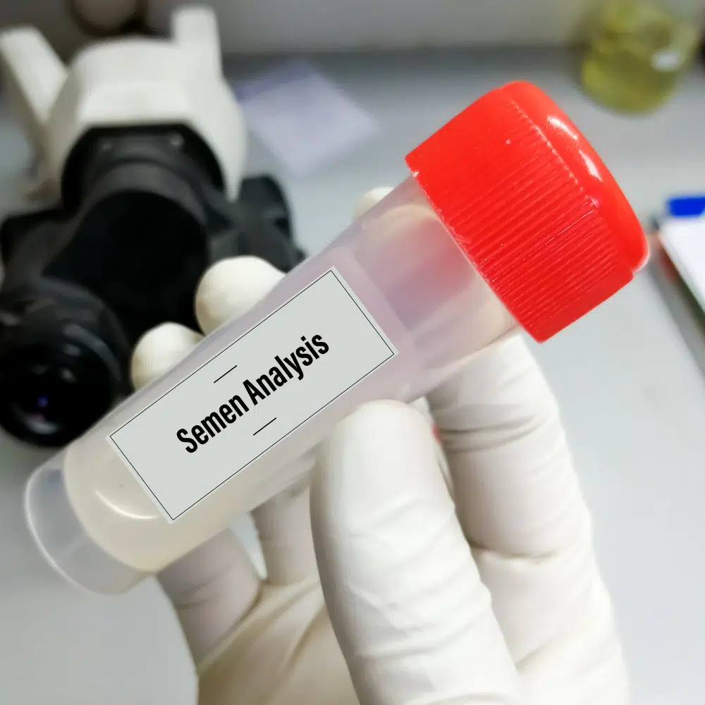 image of semen analysis- a diagnostic procedure to identify male infertility