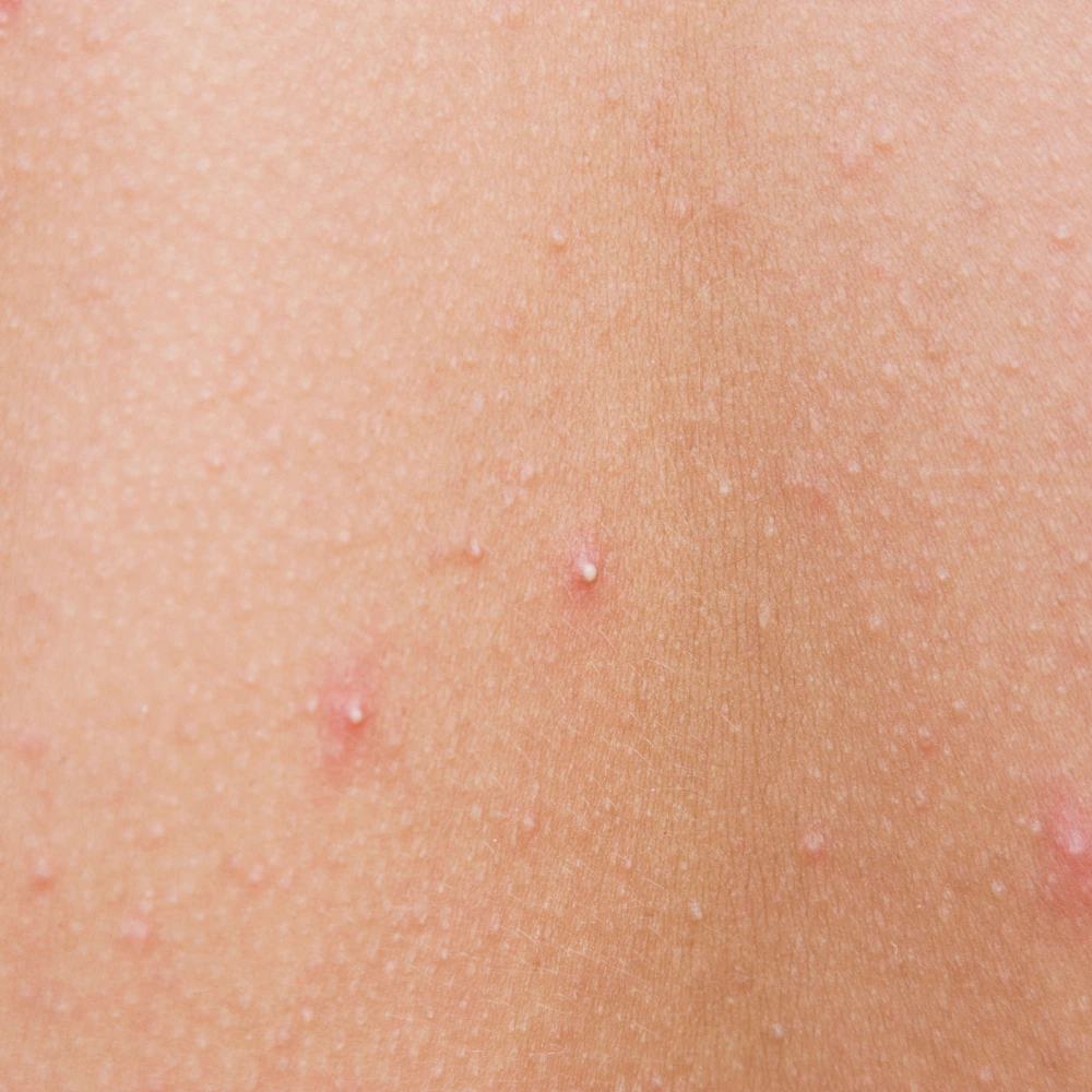 Whiteheads on skin