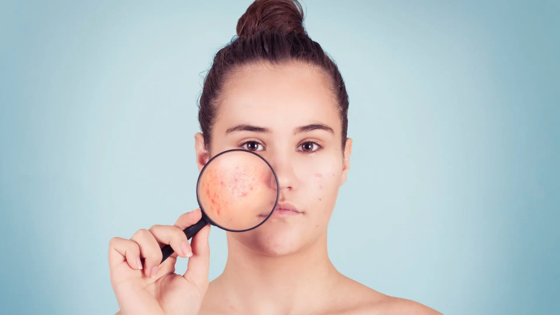 Woman uses a magnifying glass to analyze the root cause of her acne.